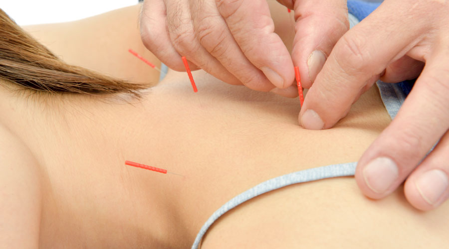 鍼灸治療 イメージ写真